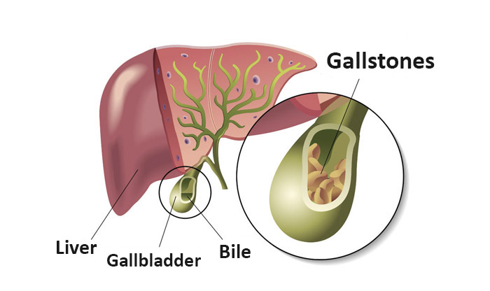 gallstones